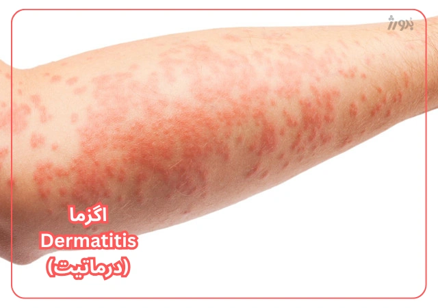 عکس مربوط به مشکلات رایج پوست بدن با کیفیت بدون بکگراند مشکل پوست - اگزما درماتیت