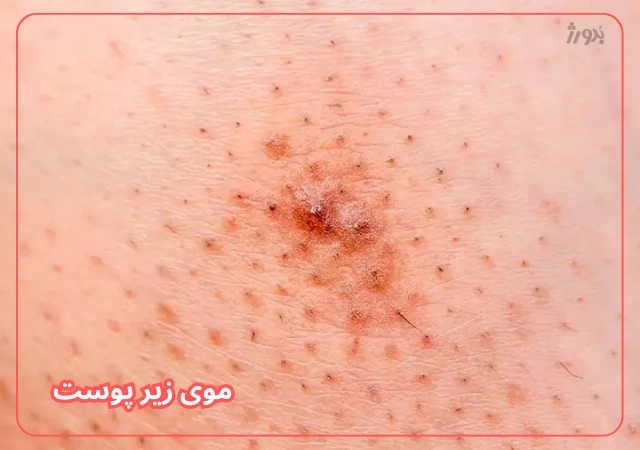 عکس مربوط به مشکلات رایج پوست بدن با کیفیت بدون بکگراند جوش زیر پوست و درمان آن