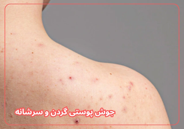 عکس مربوط به مشکلات رایج پوست بدن با کیفیت بدون بکگراند عکس جوش پشت و سرشانه