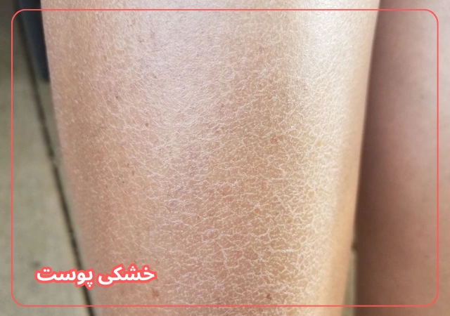 عکس مربوط به مشکلات رایج پوست بدن با کیفیت بدون بکگراند خشکی پوست بدن