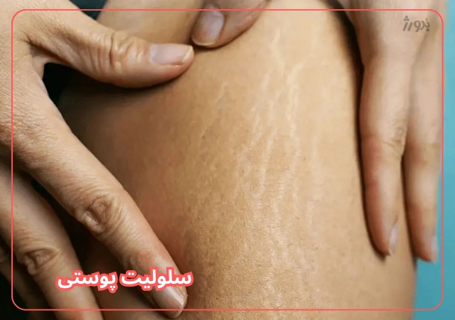 عکس مربوط به مشکلات رایج پوست بدن با کیفیت بدون بکگراند سلولیت ران و باسن پا