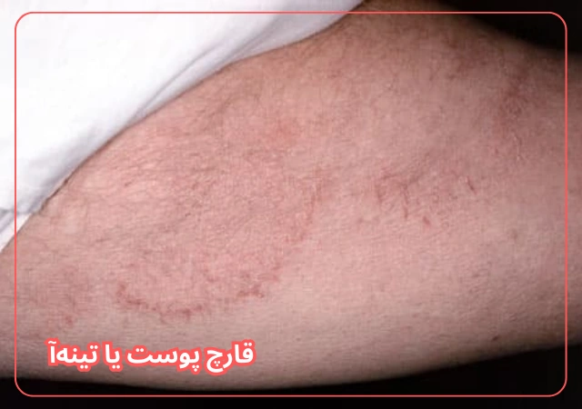 عکس مربوط به مشکلات رایج پوست بدن با کیفیت بدون بکگراند عکس بیماری قارچ پوست بدن و تینه آ