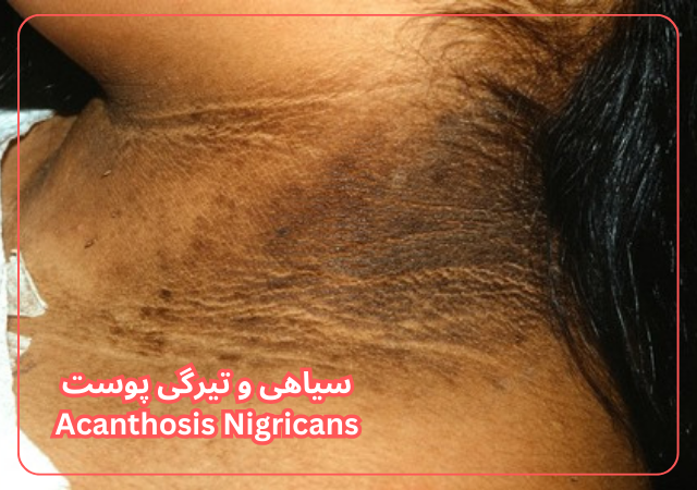 عکس مربوط به مشکلات رایج پوست بدن با کیفیت بدون بکگراند بیماری پوستی تیرگی پشت گردن