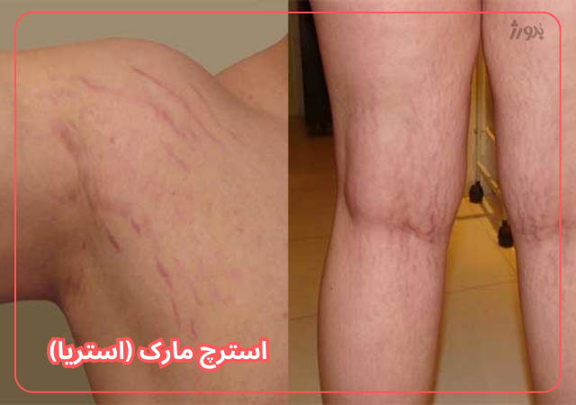 عکس مربوط به مشکلات رایج پوست بدن با کیفیت بدون بکگراند ترک پوست یا استرچ مارک زیر بغل و پست ران