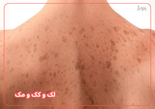 عکس مربوط به مشکلات رایج پوست بدن با کیفیت بدون بکگراند لک پوستی و کک و مک