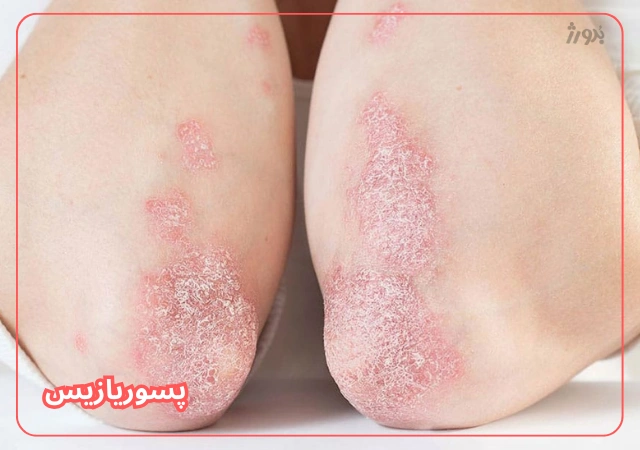 عکس مربوط به مشکلات رایج پوست بدن با کیفیت بدون بکگراند بیماری پوست پسوریازیس